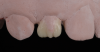 (7.) Close-up views of the cutback wax-up of teeth Nos. 7 and 10, respectively.