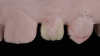 (8.) Close-up views of the cutback wax-up of teeth Nos. 7 and 10, respectively.