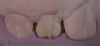 (9.) Putty guide for incisal edge verification on teeth Nos. 7 and 10, respectively.