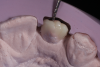 (12.) Putty guide for occlusal verification on teeth Nos. 7 and 10, respectively.