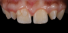 (19.) Pretreatment retracted close-up view of the maxillary arch with dots of composite placed on the maxillary right central incisor to verify the selected dentin and enamel shades.