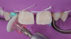 (21.) Disinfection of the maxillary lateral incisors with a 2.0% chlorhexidine gluconate solution.
