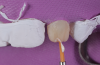 (27.) To recreate the incisal edge halo, a white resin color modifier was added to both maxillary lateral incisors with a brush and light-cured for 20 seconds.