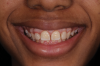 (32.) Posttreatment smile, left lateral smile, and right lateral smile photographs, respectively.