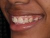 (33.) Posttreatment smile, left lateral smile, and right lateral smile photographs, respectively.