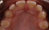 (35.) Posttreatment retracted occlusal view of the final restorations.