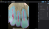 Fig 2. A periapical radiograph presented within a chairside radiologic AI interface. Clinicians can toggle on tooth part segmentations, which provides a colorized map of tooth structures to assist in case presentation and patient education.