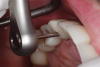 Fig 7. A specific angulated screw channel ratchet and driver being used to final torque the tooth No. 6 restoration into place. Separate instruments were used for the straight channel restoration.