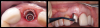 Fig 5. Left panel: Implant was placed,
leaving a gap for the bone graft and abutment. This step is crucial for developing a proper emergence profile. Right panel: The final zirconia
abutment was seated and the bone graft was packed into the gap, preventing tissue migration into the socket.