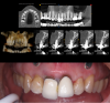 Fig 8. Top panel: Preoperative
CBCT. Note lack of alveolar bone for implant placement. Guided
bone regeneration is required to rebuild the site for future implant
placement. Bottom panel: Preoperative photograph reveals
unappealing esthetics of central incisors with elongated crowns.