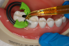 Fig 6A. Push-pull technique with (A) Contact Pro (CEJ Dental) contact-forming instrument and (B) Bioclear Push-Pull (Bioclear Matrix Systems) matrix adjusting
instrument (alternatively: Perform Contact Former, Practicon Dental).