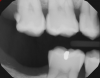 Fig 8. A 77-yearold
male patient presented with a distal lesion on tooth No. 2, previously treated with restorations that had failed.