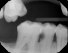 Fig 31. Preoperative radiograph showing deep caries in canal. Restoration prior to endodontic therapy is required.