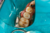 Fig 45. Finished restoration, ready for endodontic entry.