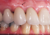 (1.) The gingival marginal tissue over the facial aspect of an ovate pontic with an 