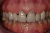 (7.) Pretreatment retracted close-up view of two defective 3-unit fixed partial dentures spanning teeth Nos. 6 through 8 and teeth Nos. 9 through 11.