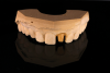 (5.) The tooth on the model was prepared for a traditional crown with the gingival margins ideally placed.