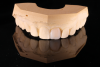 (6.) Using dentin opacity composite, the tooth shell was shaped directly onto the prepared tooth on the model.