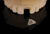 (8.) The composite was cured, and the tooth shell was snapped off of the model. Then, the stone inside of it and the composite flash at the margins were removed.