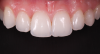 (31.) Smile, retracted, and close-up views of the provisional restoration at the 4-month follow-up appointment to assess the development of tissue volume and contours. Note that most of the open gingival embrasures have filled with papillae and that the gingival zenith exhibits excessive volume.