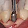 (35.) An implant being inserted into the prepared osteotomy of a patient who presented for the replacement of the maxillary left central incisor.
