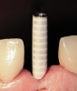 (38.) The opaqued titanium provisional abutment was gently tightened onto the implant.