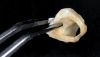 (48.) The natural tooth pontic was modified into a shell that resembled a three-quarter crown restoration, and then it was etched and bonded.