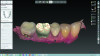 Fig 8. Digital designing of occlusal surface.