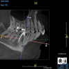 (9.) An original finding of a small lesion on the mesial root of tooth No. 30 was not accompanied by any outward symptoms; therefore, the patient delayed pursuing treatment. When a follow-up CBCT scan was acquired 6 years later, the easy-to-visualize increase in the dimensions of the lesion motivated the patient to elect a treatment plan.