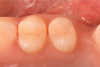 (5.) Follow-up photograph of the final restorations taken 3 months postoperatively.