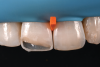 (9.) Composite was placed into a silicone index to mold the palatal and incisal margins, and then the interproximal walls were restored with interproximal matrices.