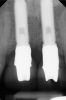 Fig 2. Baseline periapical x-ray.