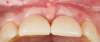 Fig 18. Clinical comparison of the volumetric gain obtained with the intervention, occlusal views. Fig 17: Occlusal view at baseline. Fig 18: Occlusal view at 1-year post-treatment.