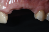 Fig 2. Buccal clinical view at baseline.