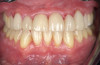 Fig 3. After orthodontic treatment with clear aligner therapy in the same patient shown in Fig 1 and Fig 2, restorative treatment of the teeth affected by attrition was
performed. This photograph shows a post-treatment retracted view of final porcelain-fused zirconia crowns on teeth Nos. 5 through 12.