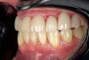 Fig 4. Post-treatment retracted left
lateral view of the final porcelain-fused zirconia crowns in this same patient.