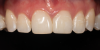 (5.) Pretreatment and posttreatment close-up photographs of maxillary central incisors treated with internal bleaching and direct composite veneers.