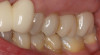 (5.) Teeth Nos. 13, 14, and 15 appear to be crowns, but are actually a bridge.