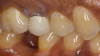 (9.) A patient was unhappy with the appearance of a PFM crown.