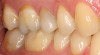 (10.) A crown was placed on tooth No. 4.