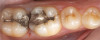 (11.) A failing amalgam restoration on tooth No. 30 still possesses some healthy tooth structure on the mesial aspect.