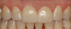 (17.) Two cases in which teeth Nos. 8 and 9 were restored.