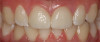 (18.) Two cases in which teeth Nos. 8 and 9 were restored.