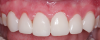 (6.) Posttreatment retracted close-up view of the composite veneers after they were placed with a self-adhesive resin cement.