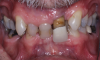 (7.) Pretreatment retracted view of a 60-year-old male patient who presented to receive comprehensive care and full-mouth rehabilitation to enhance his function, stability, and esthetics. Due to his malocclusion at the time of presentation, adult orthodontic treatment was recommended. Given the patient’s anterior deep vertical overlap, the decision was made to temporarily challenge his vertical dimension of occlusion to facilitate ease of bracketing the mandibular anterior teeth. This was to be achieved with posterior full-coverage composite crowns.