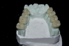 (9.) View of the maxillary and mandibular posterior full-coverage composite crowns, which were designed and milled with an increased vertical dimension position. This position was determined after intraoral testing was conducted with a leaf gauge instrument.