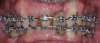 (11.) Retracted view of the patient after the initiation of orthodontic treatment. Upon completion of the orthodontic treatment, the patient will receive a full-mouth prosthetic rehabilitation with ceramic crowns. Tooth No. 9 was retained for implant site development but would eventually be extracted to place an implant-supported crown.
