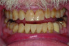 Close-up view of patient’s dentition in 2009.