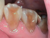 Severe buccal erosion, Nos. 28 and 29. Note shadow of pulp chambers.