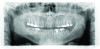 Panoramic radiograph taken in 2017. Note increased occlusal erosion of tooth No. 18.